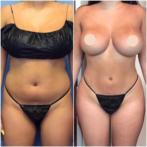 Liposuction Images - Perfect Doctors Clinic | Aesthetic & Plastic Surgery Clinic in Dubai